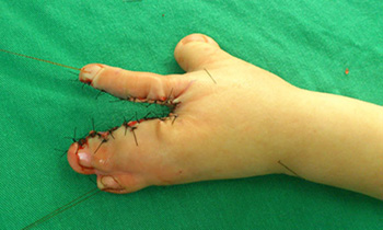 Cirugía de la mano congénita